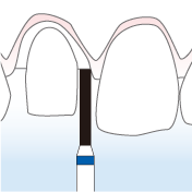歯茎の仕上げラインの形成